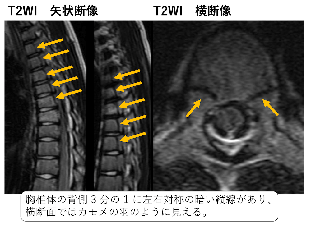 脊椎の正常変異の椎弓癒合不全・欠損の種類と画像所見のポイント