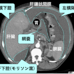 CT-anatomy-of-peritoneal-