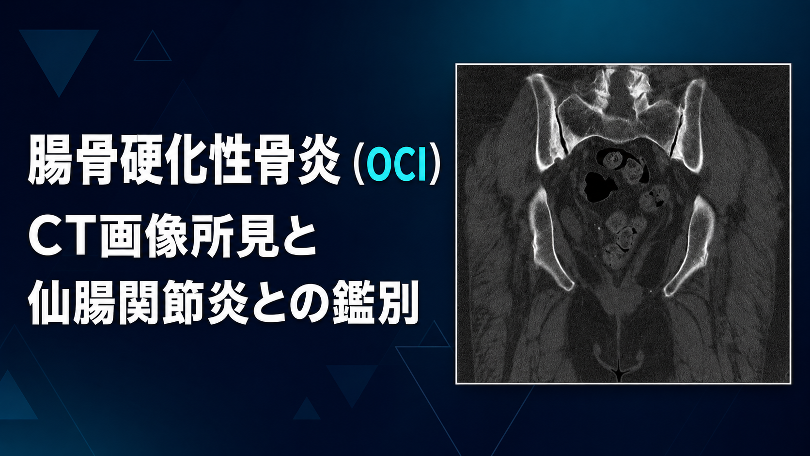 腸骨硬化性骨炎（OCI）のCT画像所見と仙腸関節炎との鑑別