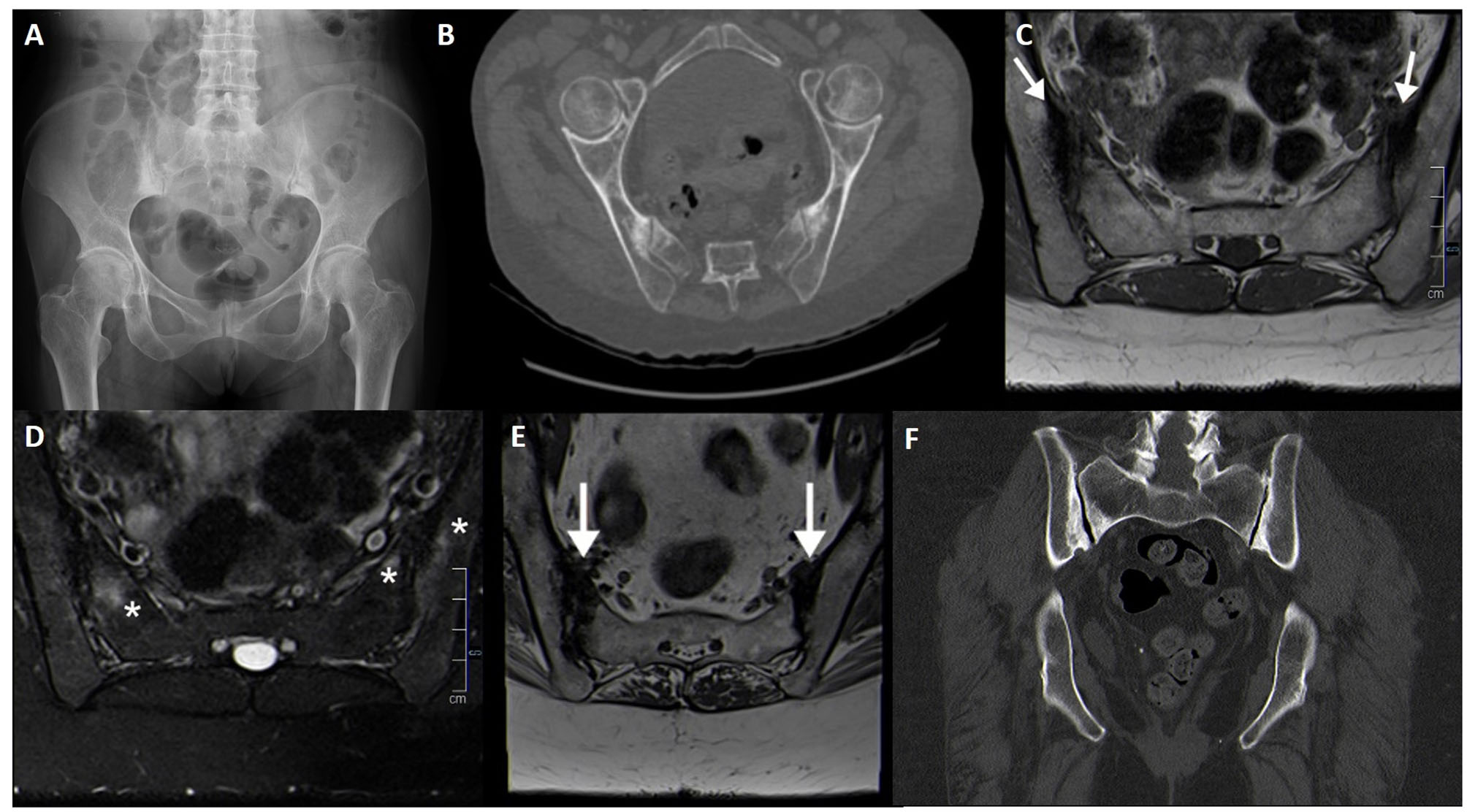 腸骨硬化性骨炎のX線・CT・MRI例。CTで両側仙腸関節の腸骨側優位の骨硬化を示す