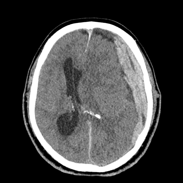 急性硬膜下血腫 正中偏位 CT
