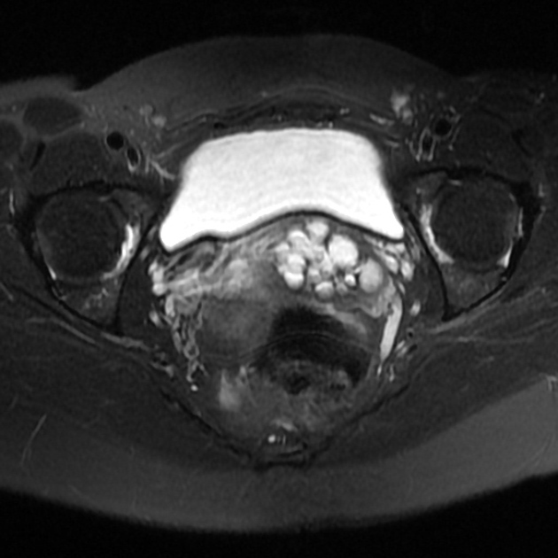 悪性腺腫(子宮頸部胃型腺癌) MRI T2強調像 横断像