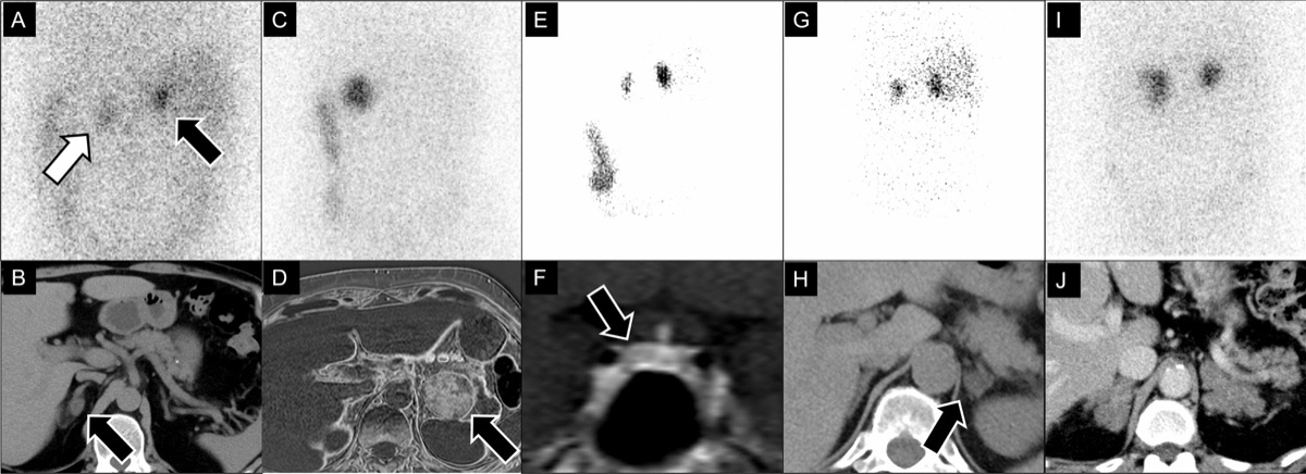 副腎皮質シンチ(131I-adosterol)後面像とCT・MRI 症例の比較