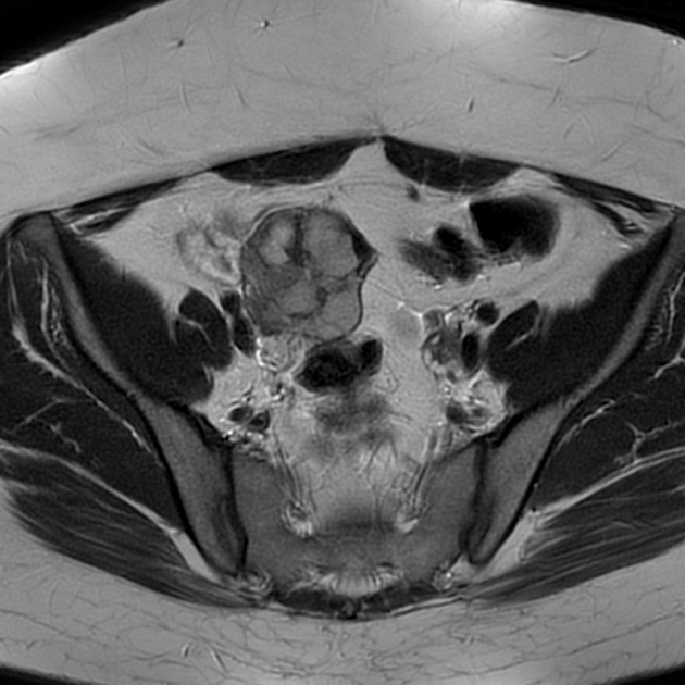 成人型顆粒膜細胞腫 MRI T2強調像