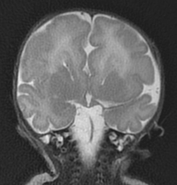 脳梁欠損症 MRI T2強調像 冠状断像