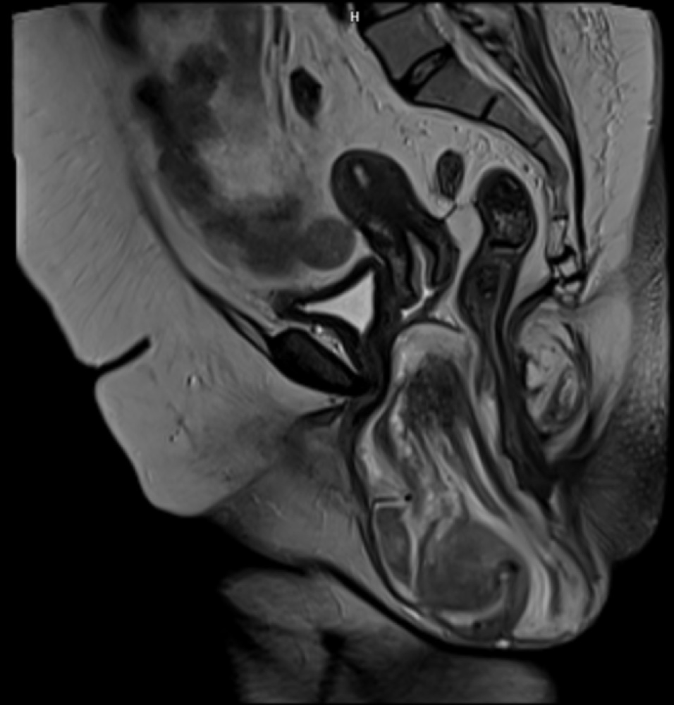 侵襲性血管粘液腫 MRI T2強調像 矢状断像