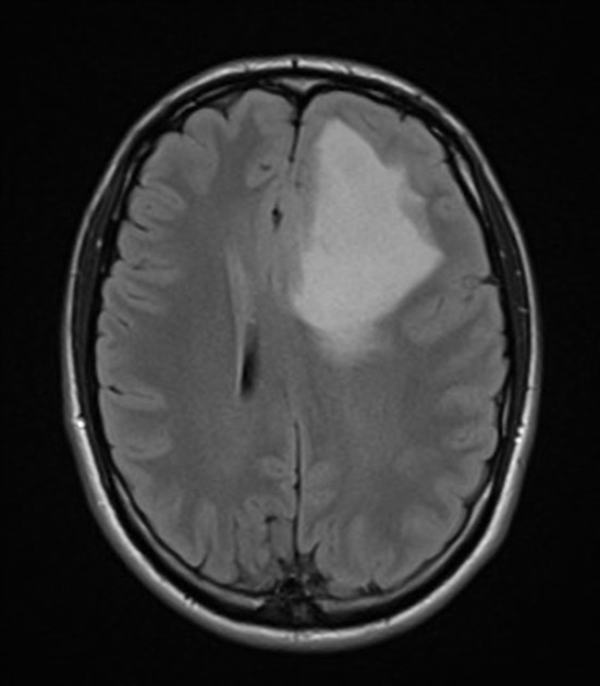 退形成性星細胞腫 MRI FLAIR像 横断