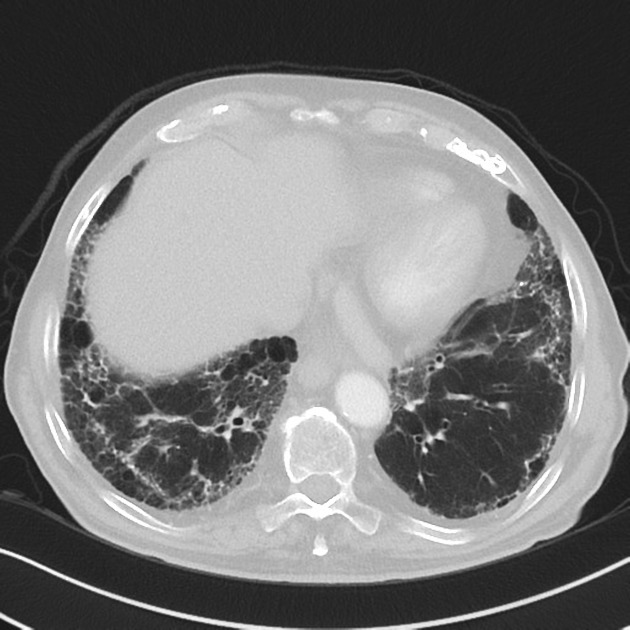 石綿肺 CT