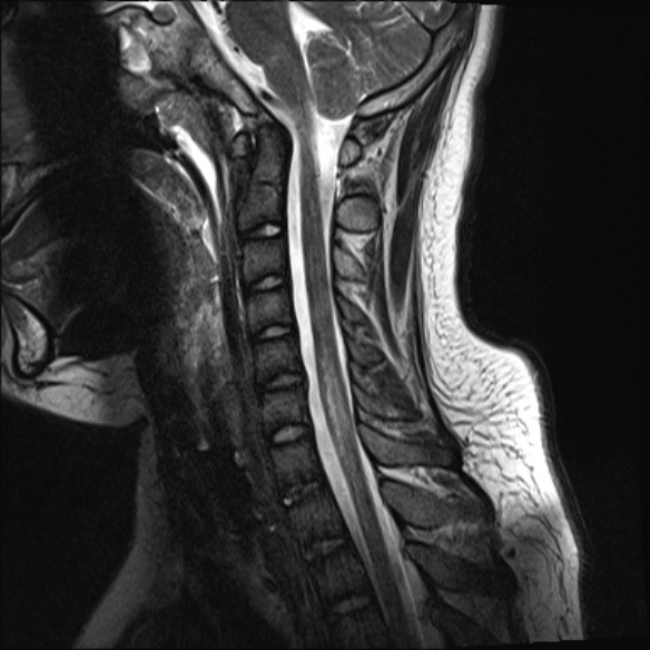 横断性脊髄炎 頸髄 長大病変 MRI T2強調矢状断