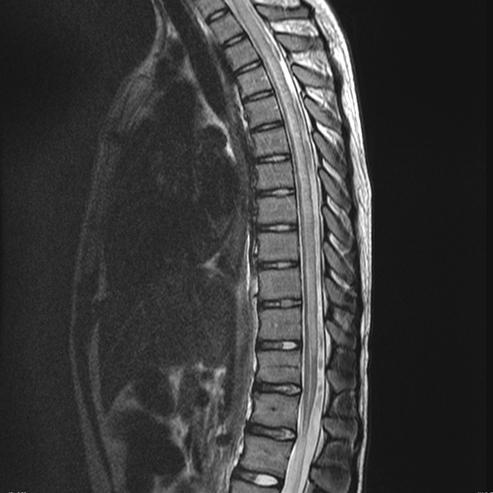 視神経脊髄炎スペクトラム障害 胸髄 長大病変 MRI T2強調矢状断