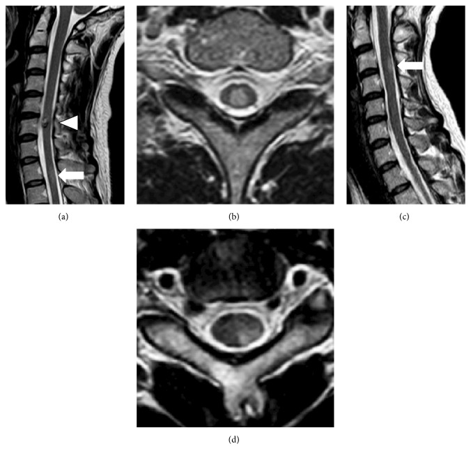 アトピー性脊髄炎 MRI T2強調像