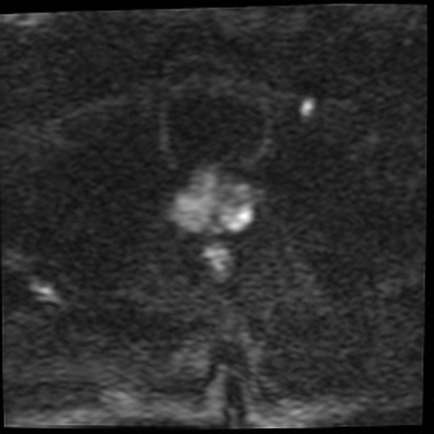 BCG後 肉芽腫性前立腺炎 MRI 拡散強調像