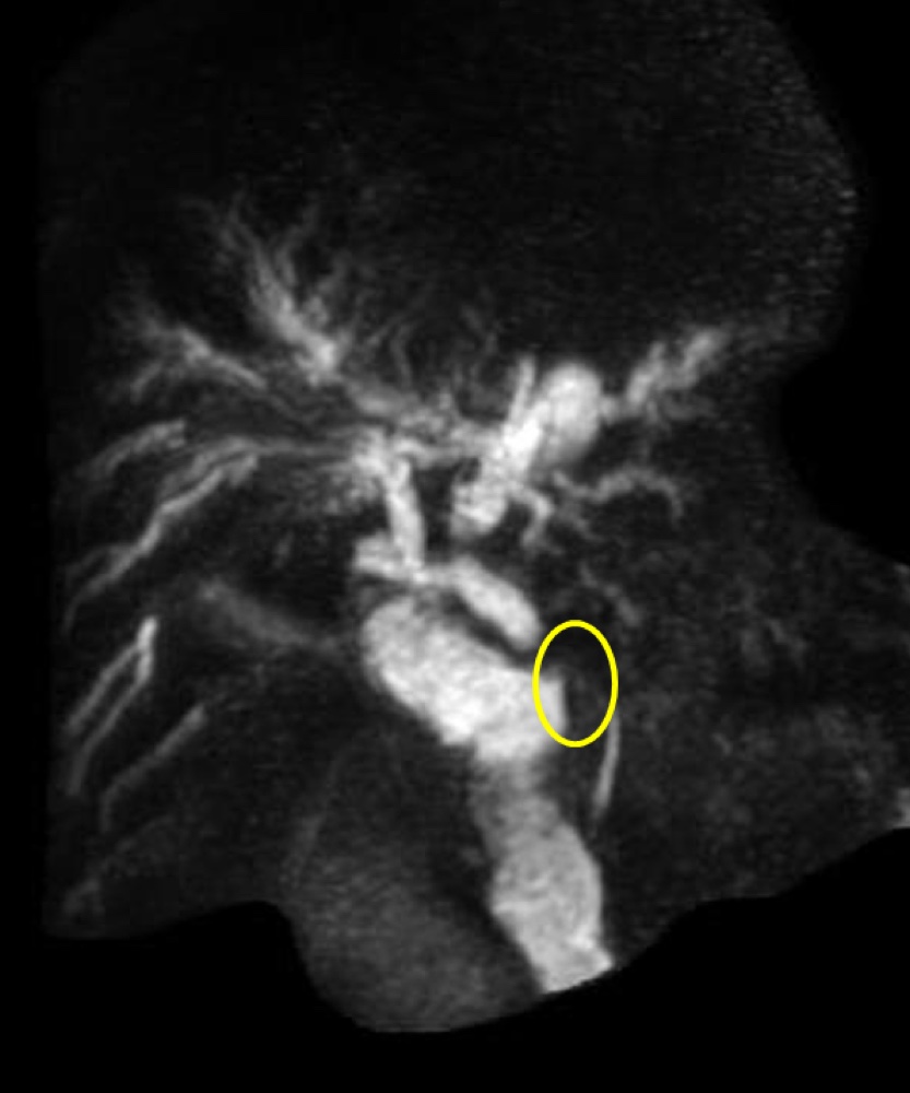 門脈性胆道症 MRCP