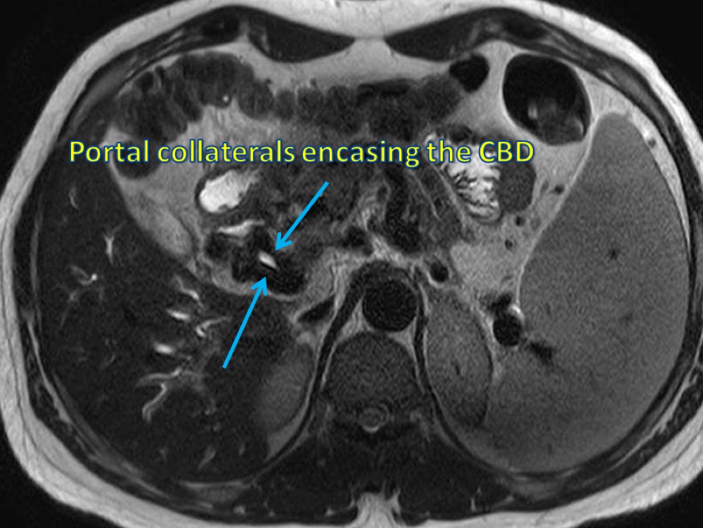 門脈性胆道症 MRI T2強調像 横断像