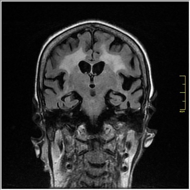 Binswanger病 MRI FLAIR像 冠状断像