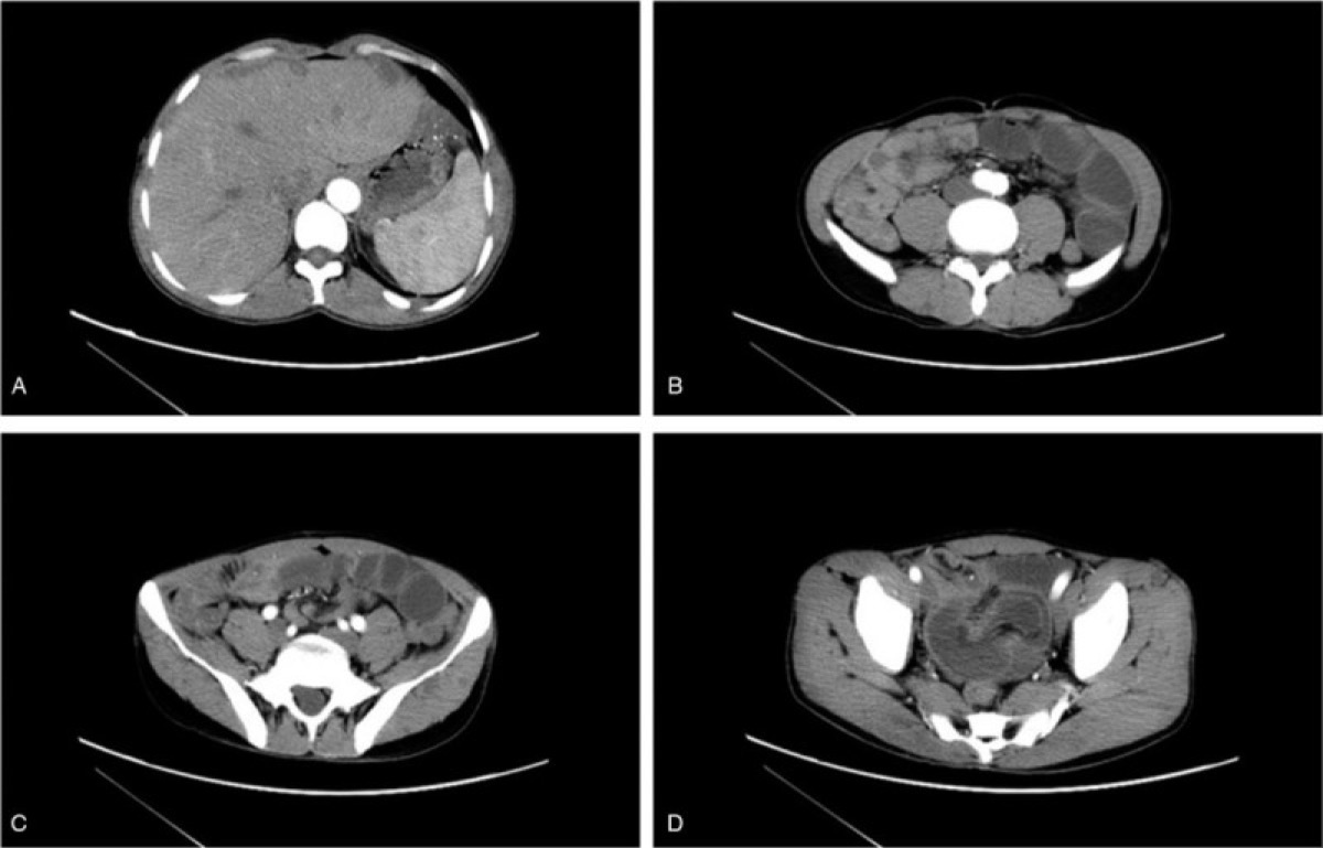 青色ゴムまり様母斑症候群 造影CT 腸重積 肝血管腫