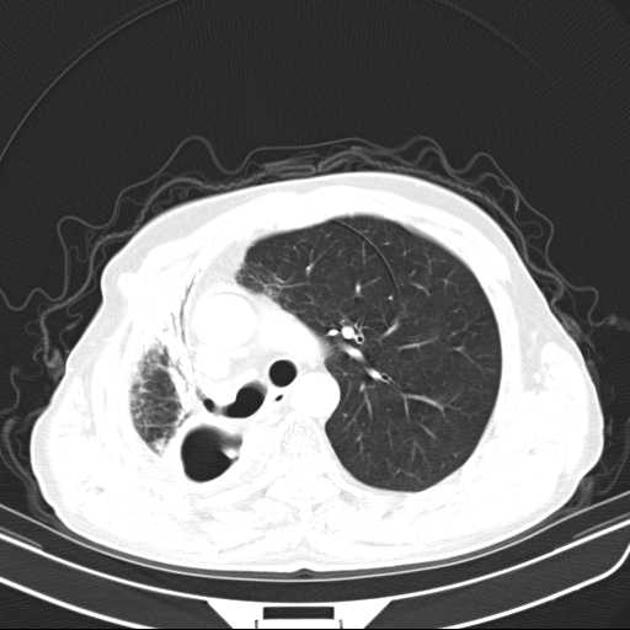 気管支断端瘻 CT 肺野条件 横断像