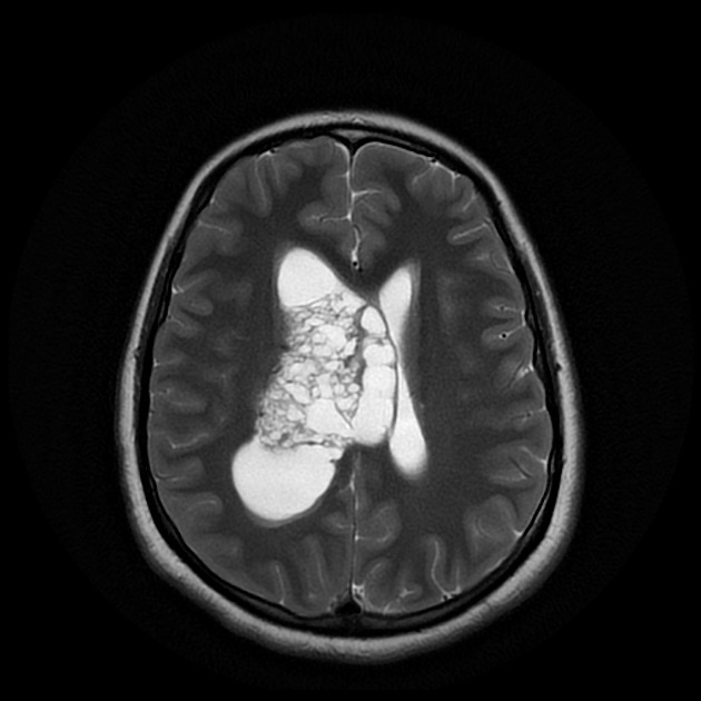 中枢性神経細胞腫 MRI T2強調像 横断