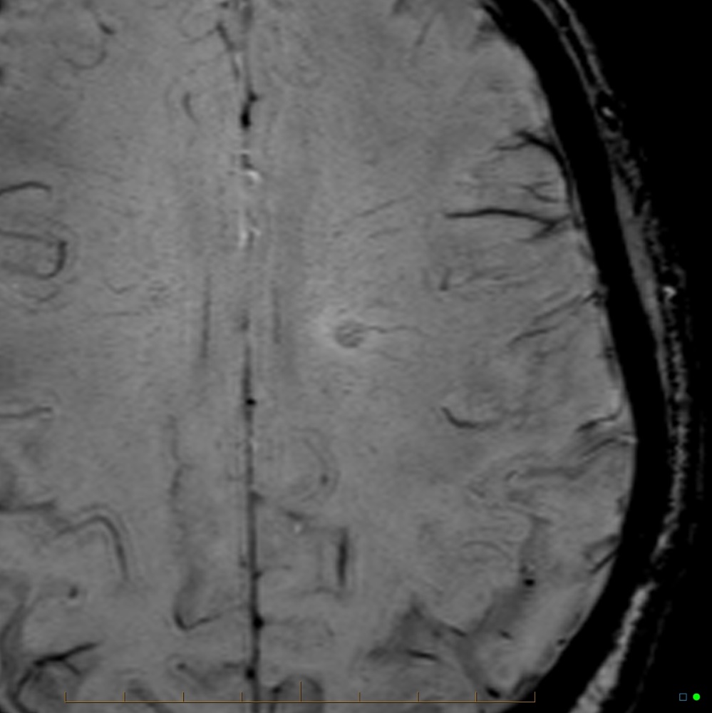 多発性硬化症 central vein sign 頭部MRI SWI 横断像(拡大)