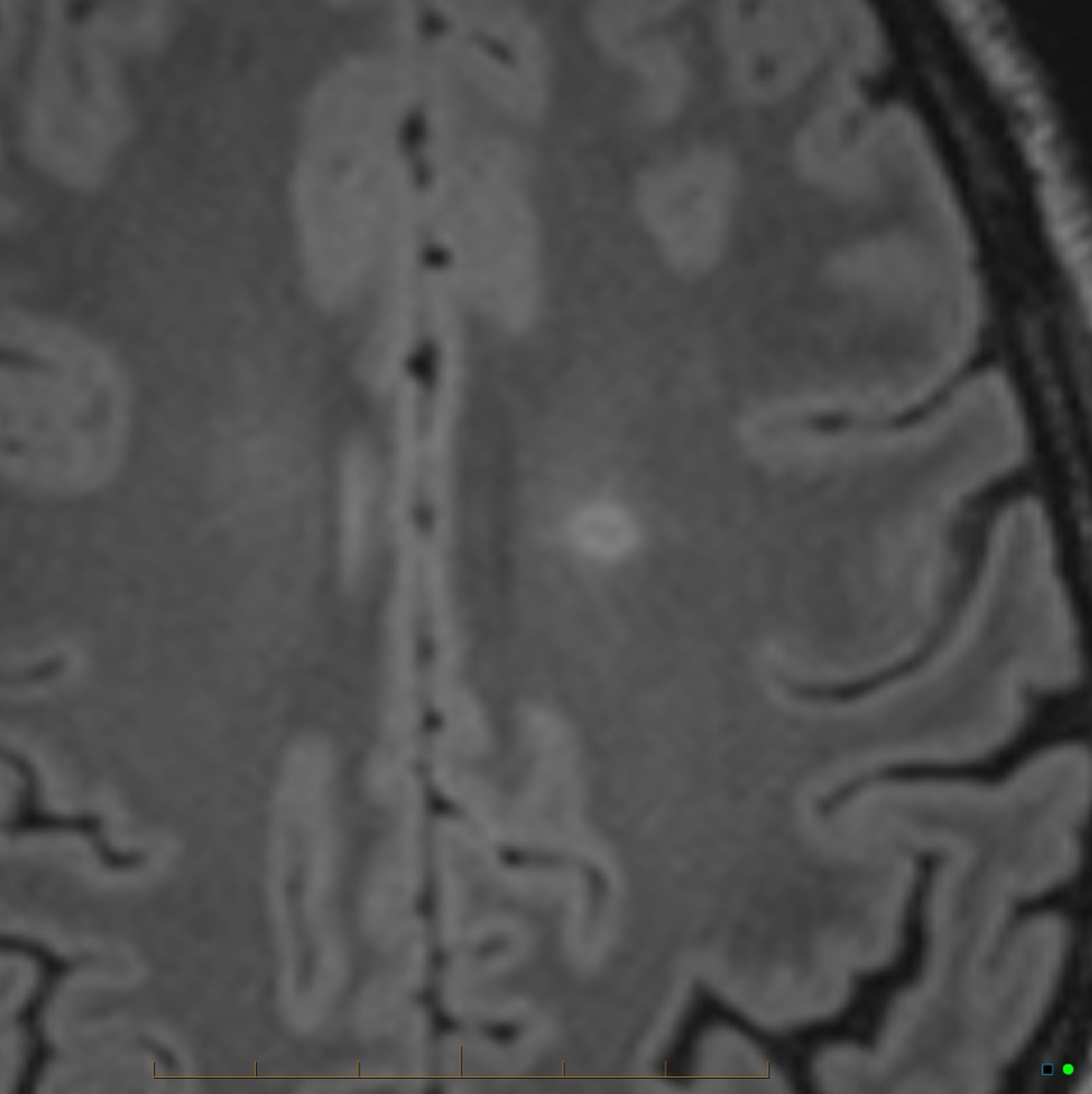 多発性硬化症 頭部MRI FLAIR 横断像(拡大)