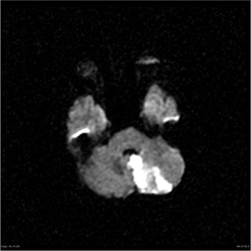 小脳梗塞(PICA領域) MRI 拡散強調像(DWI) 横断像