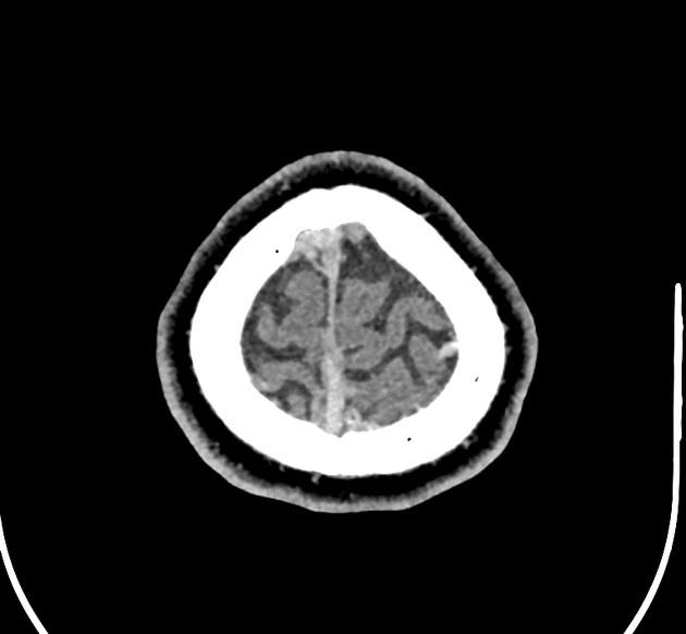 抗リン脂質抗体症候群による静脈洞血栓症 単純CT 横断像
