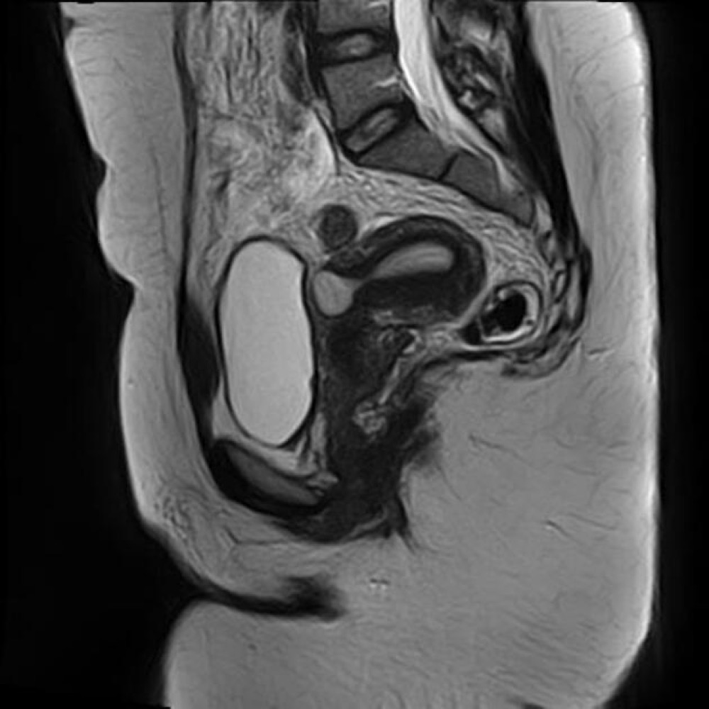 帝王切開瘢痕のニッチ MRI T2強調像 矢状断像
