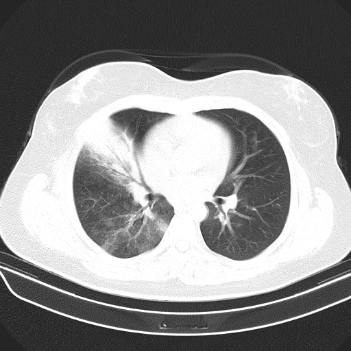 肺炎クラミジア肺炎 CT