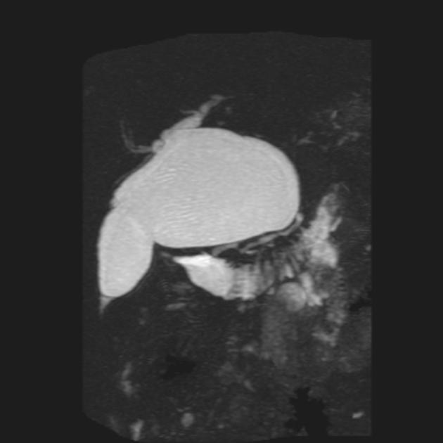 先天性胆管拡張症(総胆管嚢腫 Todani I型) MRCP MIP像