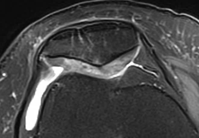 膝蓋骨軟骨軟化症 MRI プロトン密度強調脂肪抑制像 横断像(膝蓋骨部拡大)