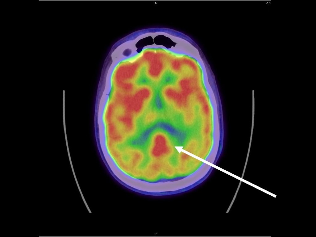 cingulate island sign FDG PET/CT 軸位断像 レビー小体型認知症