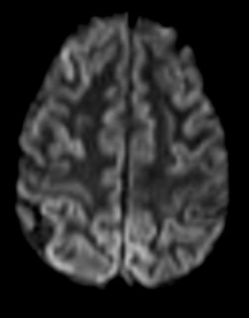クロイツフェルト・ヤコブ病 MRI 拡散強調像