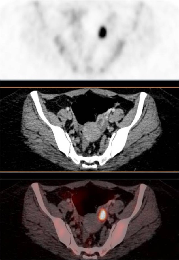 黄体嚢胞 FDG-PET/CT 横断