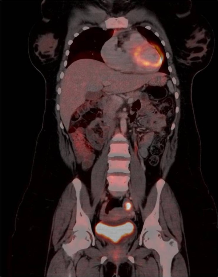 黄体嚢胞 FDG-PET/CT 冠状断