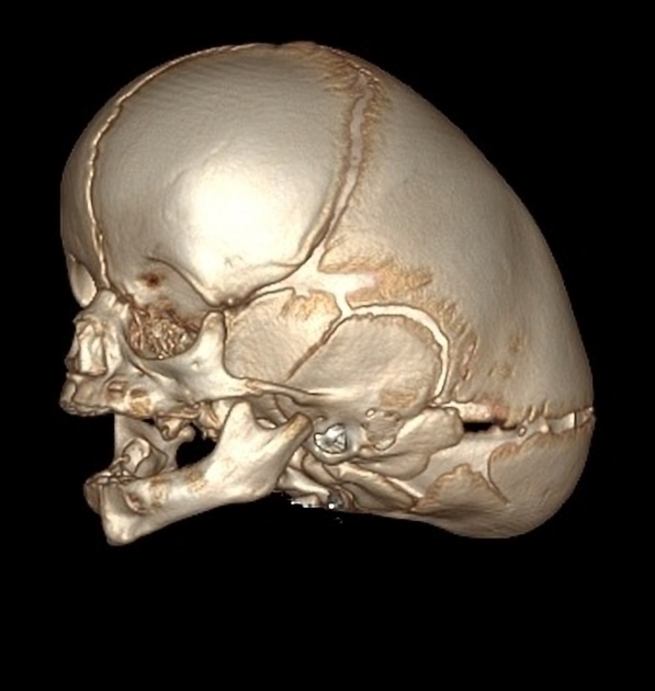 矢状縫合早期癒合症 舟状頭 3D CT 側面