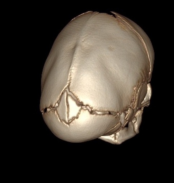 矢状縫合早期癒合症 舟状頭 3D CT 後ろ上方から