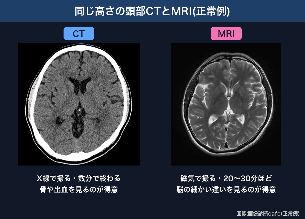 同じ高さの頭部CTとMRI(正常例)の比較画像