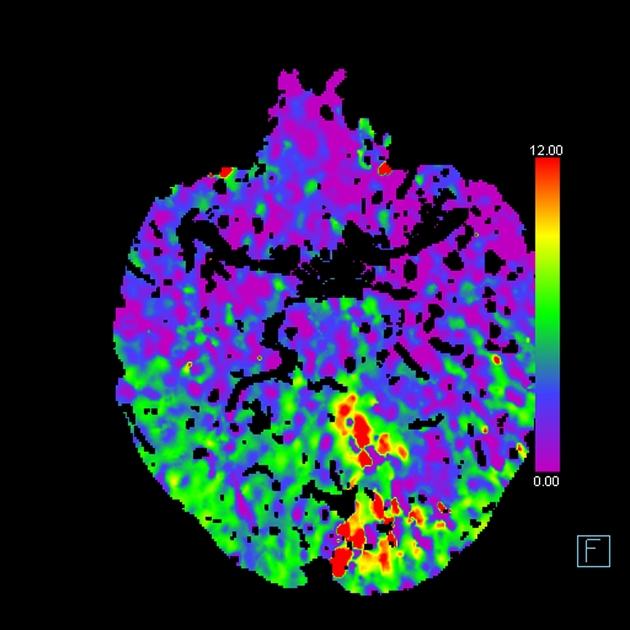 左後大脳動脈P1閉塞 CT perfusion Tmaxマップ