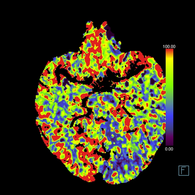 左後大脳動脈P1閉塞 CT perfusion CBFマップ