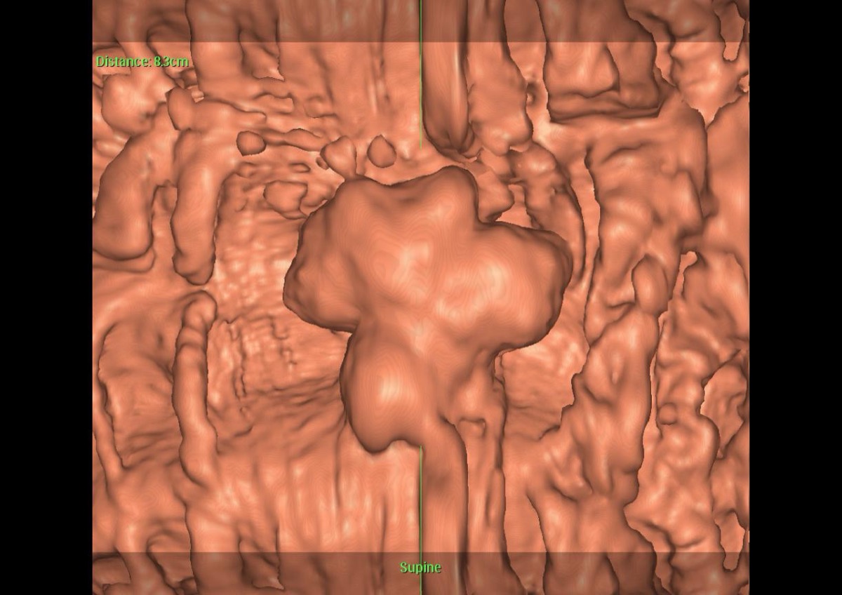 CTコロノグラフィ 3D仮想内視鏡像 上行結腸ポリープ