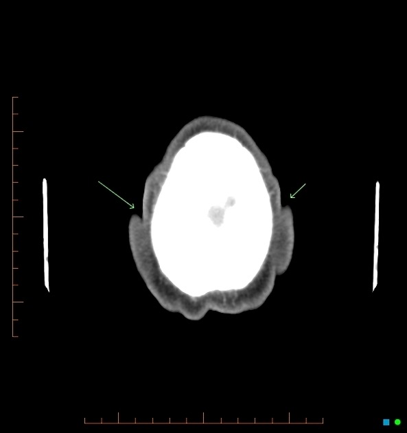 脳回状頭皮 CT 横断像