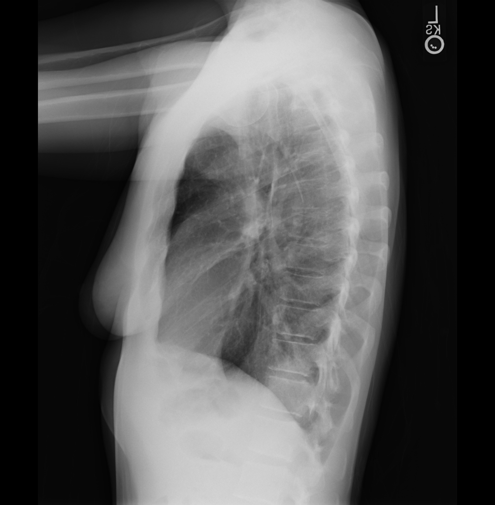 左下葉の浸潤影 胸部側面X線 spine sign
