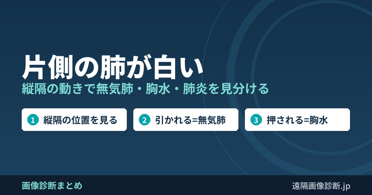 片側の肺が白い 縦隔の動きで無気肺・胸水・肺炎を見分ける