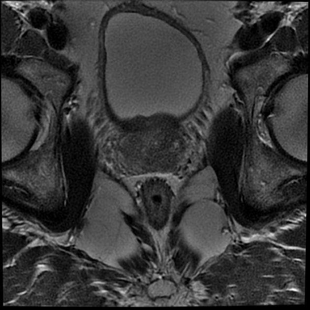 BCG後 肉芽腫性前立腺炎 MRI T2強調像