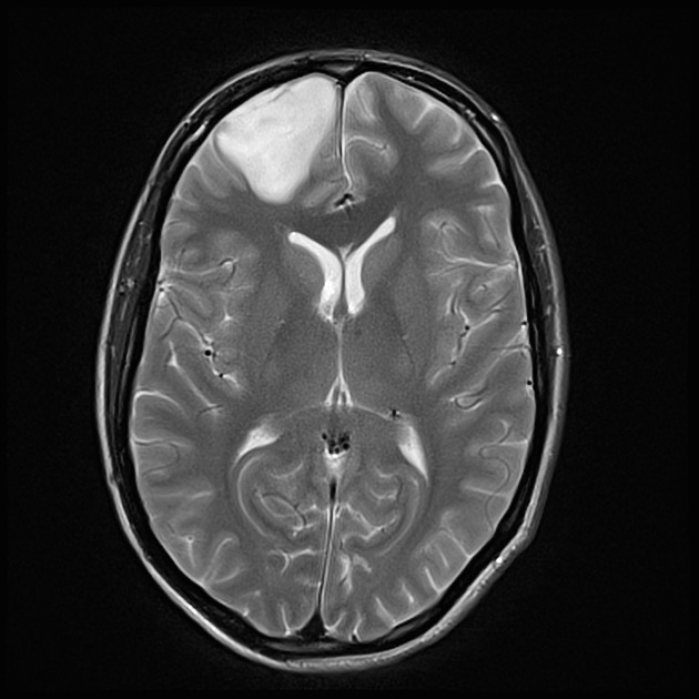 びまん性星細胞腫(星細胞腫, IDH変異型) MRI T2強調像 横断