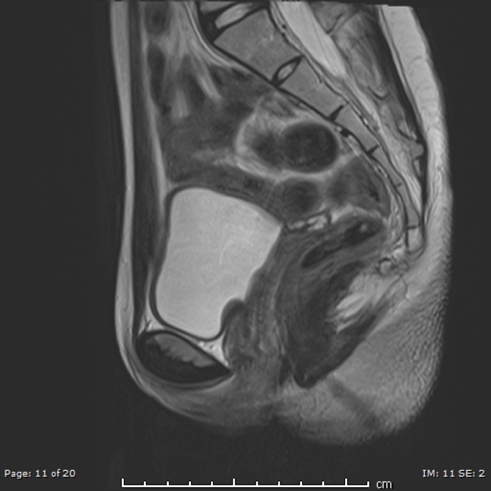 アンドロゲン不応症 MRI T2強調像 矢状断像