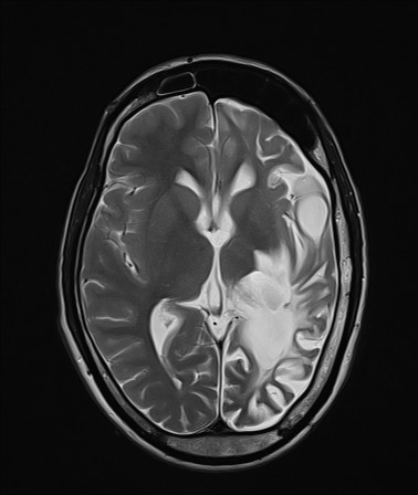 Dyke-Davidoff-Masson症候群 MRI T2強調像 横断像