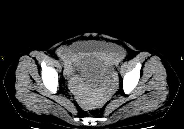 異所性妊娠破裂 sentinel clot sign 非造影CT 骨盤部 横断像