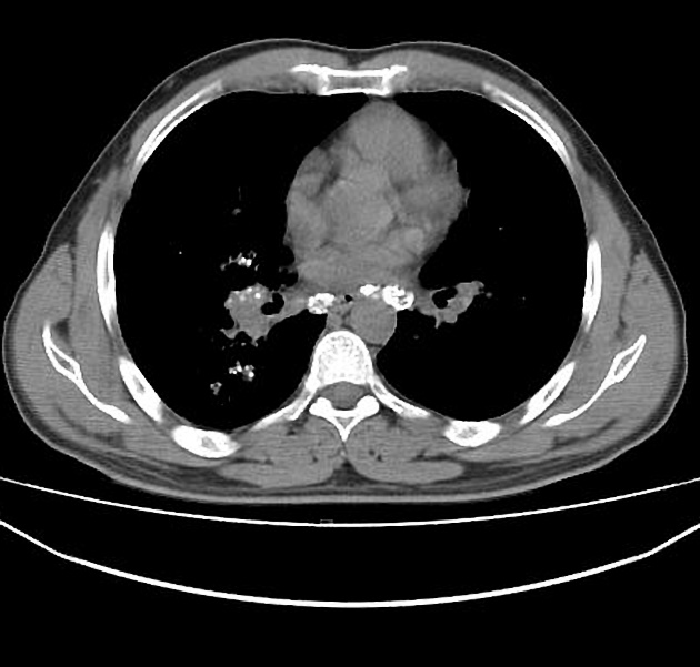 珪肺 リンパ節の卵殻状石灰化 CT