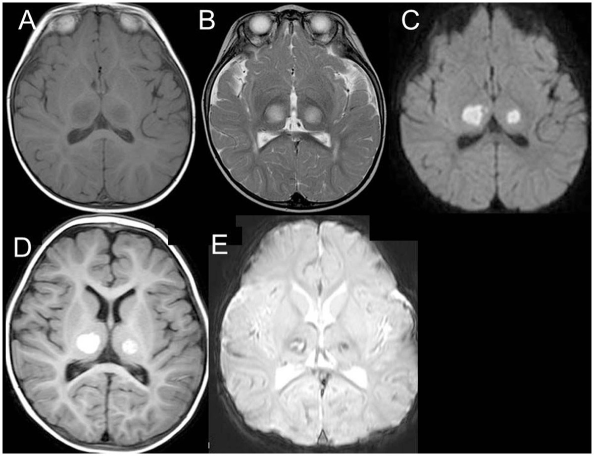 急性壊死性脳症 両側視床病変 T1・T2・DWI・T2*(1歳男児)